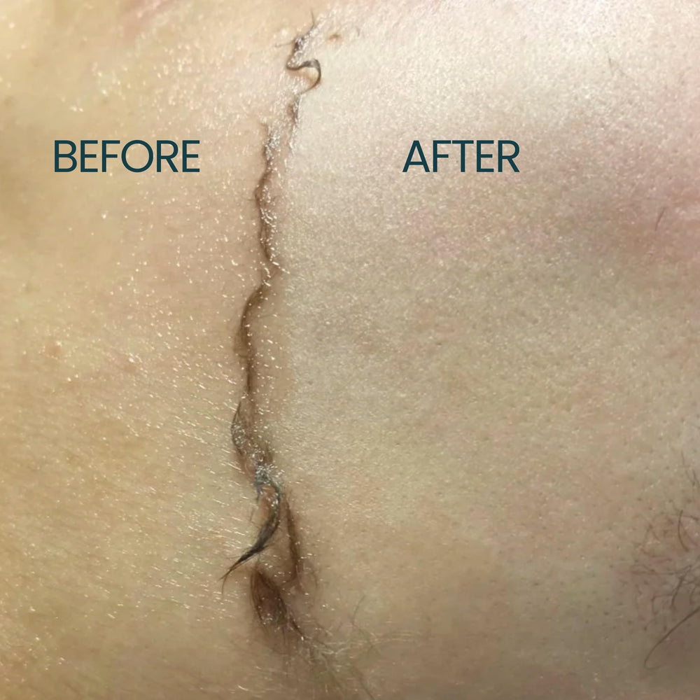 Protection légère contre irritations lors du rasage avec Dermaplane.