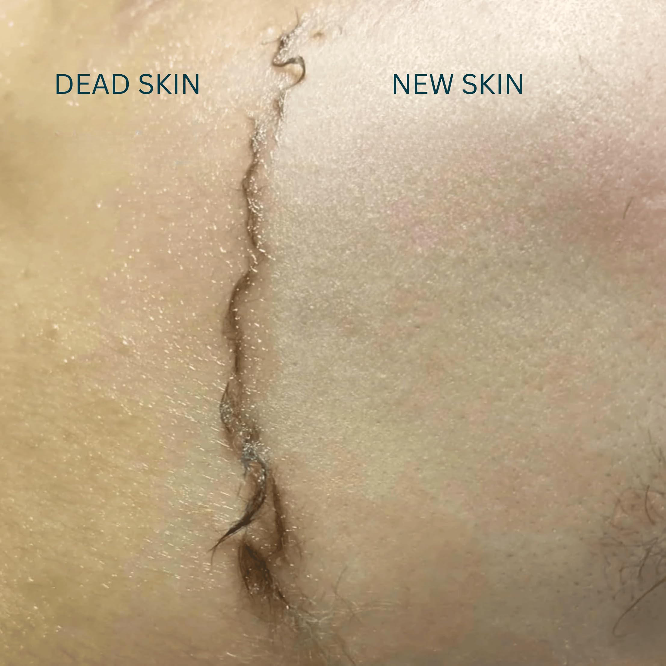 Peau grasse sublimée par l’huile dermaplaning non comédogène Ouiloe