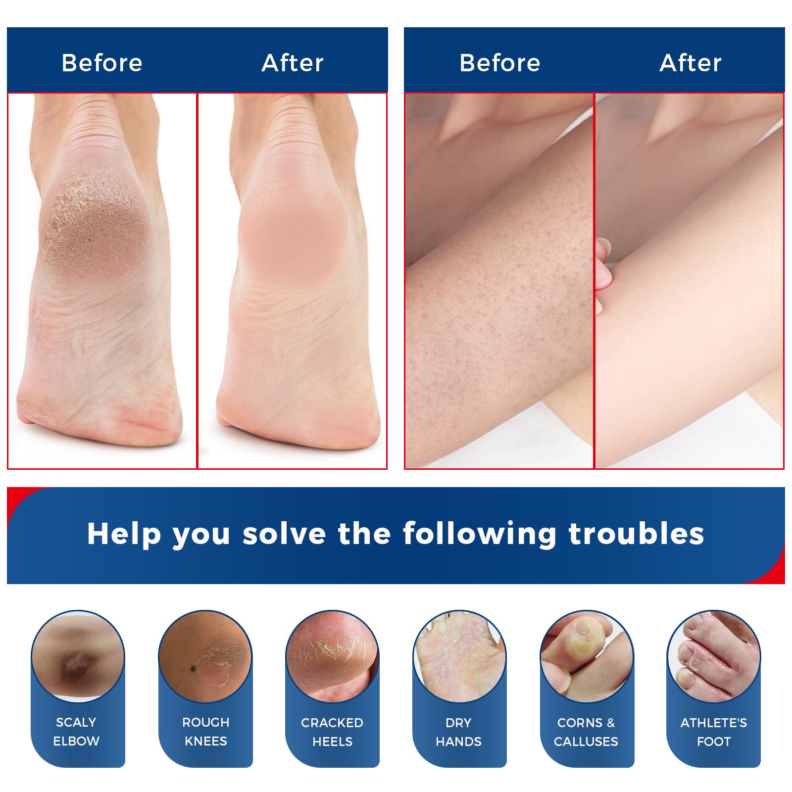 Texture sans huile OUKEYA Crème Urea 40% pour routine quotidienne agréable.