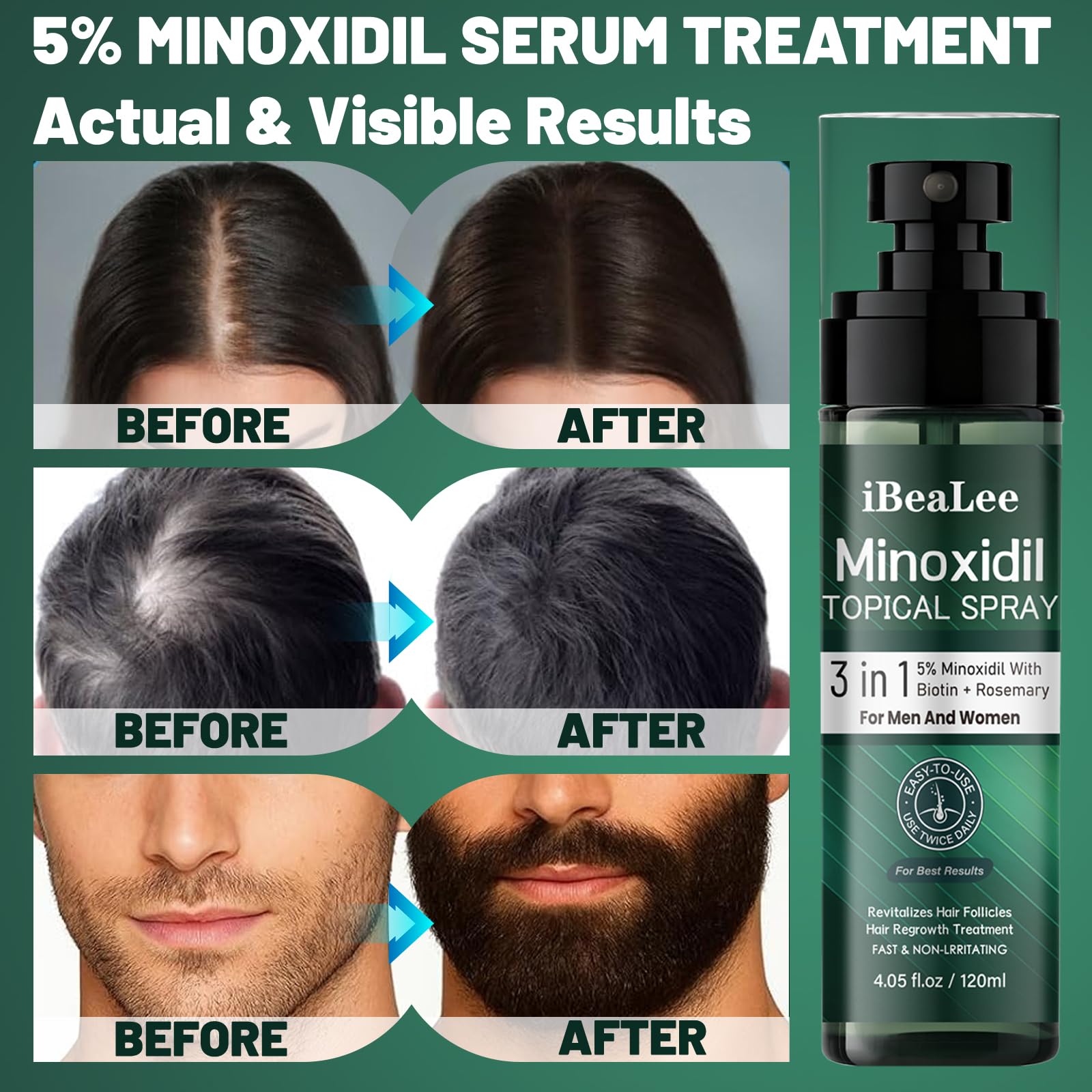 OURMUST Minoxidil 5% peut aider à des cheveux plus forts et plus épais.