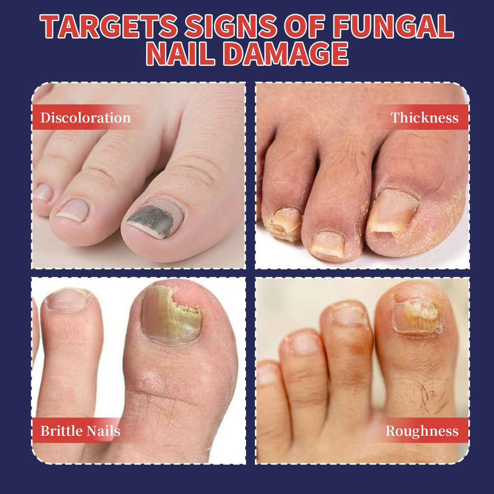 Patch antifongique Extra Force pour ongles d'orteil – usage nocturne efficace.
