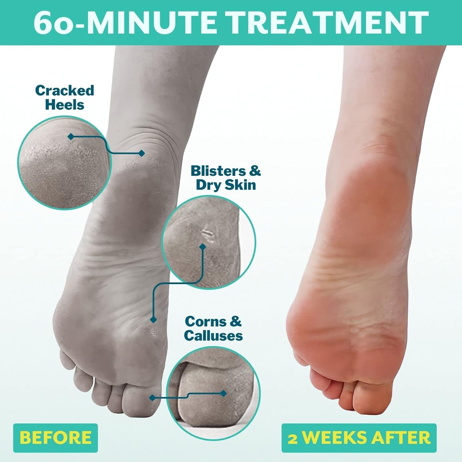 Patchology PoshPeel Pedi Cure – exfoliation-progressive qui révèle une peau plus douce.