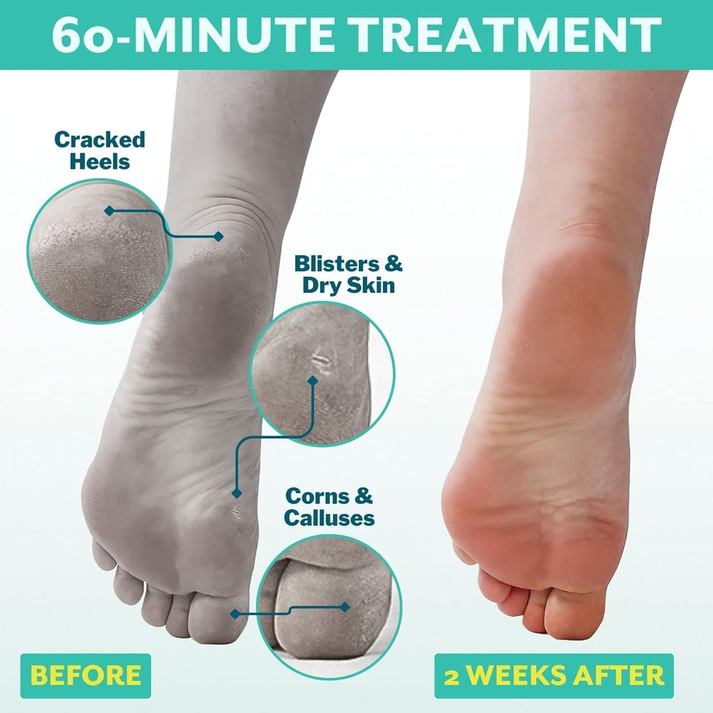 Patchology PoshPeel Pedi Cure – exfoliation-progressive qui révèle une peau plus douce.