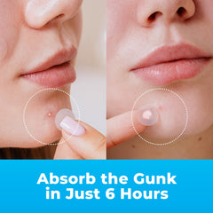 PatchRx tailles bandes visage: options petites, moyennes et grandes pour un ajustement discret.