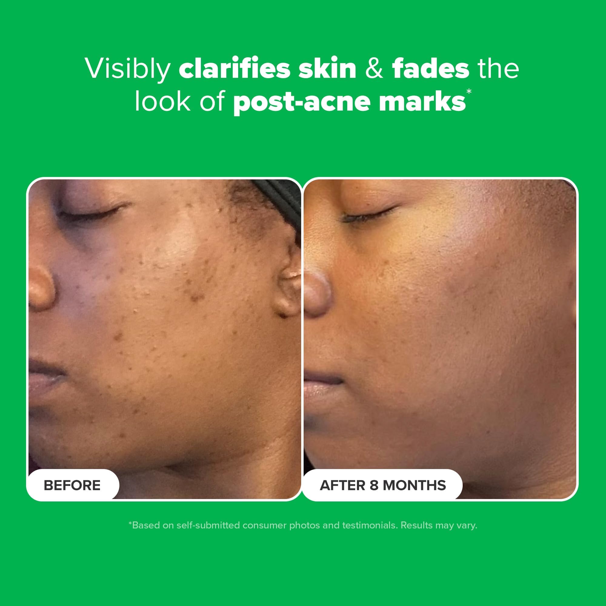 Paula's Choice Boost on blemish area sample.