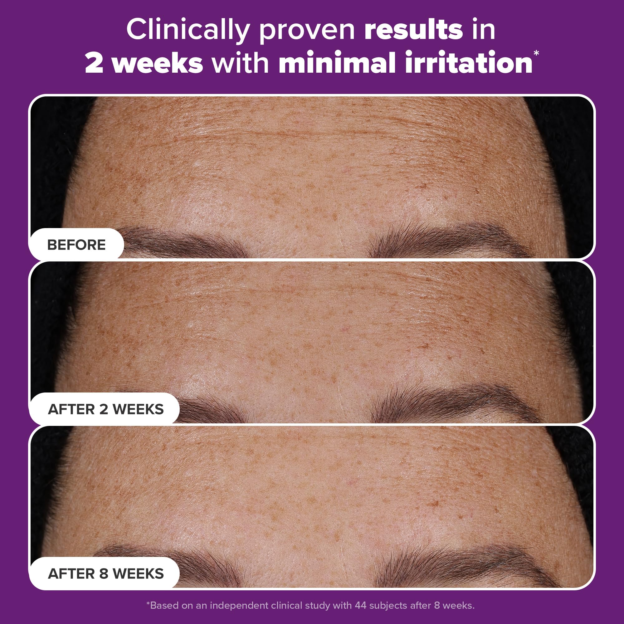 Pores affinés avec Paula's Choice Pro‑Rétinaldéhyde après usage régulier.