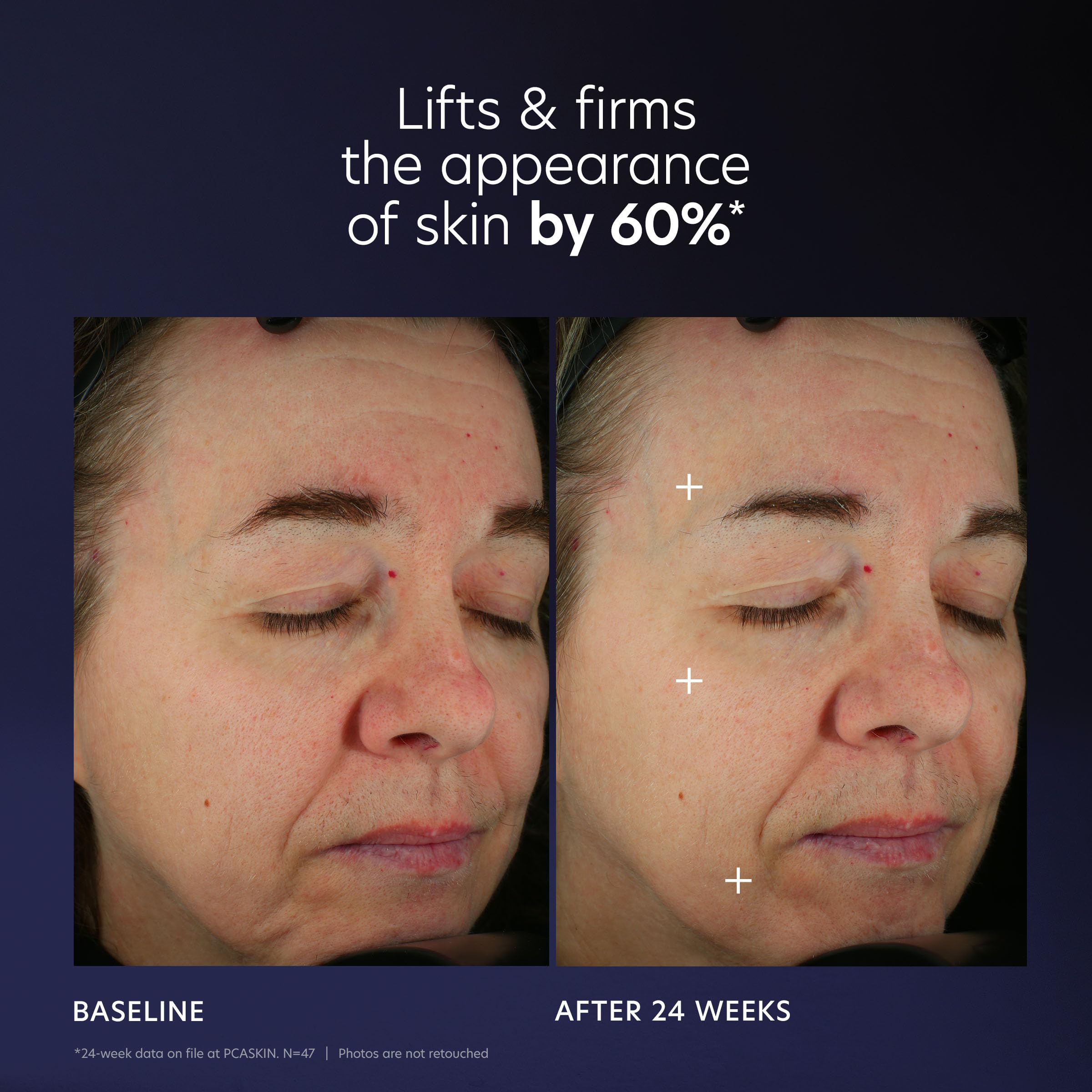 Utilisation quotidienne sur visage et cou du PCA SKIN Pro Max Age Renewal