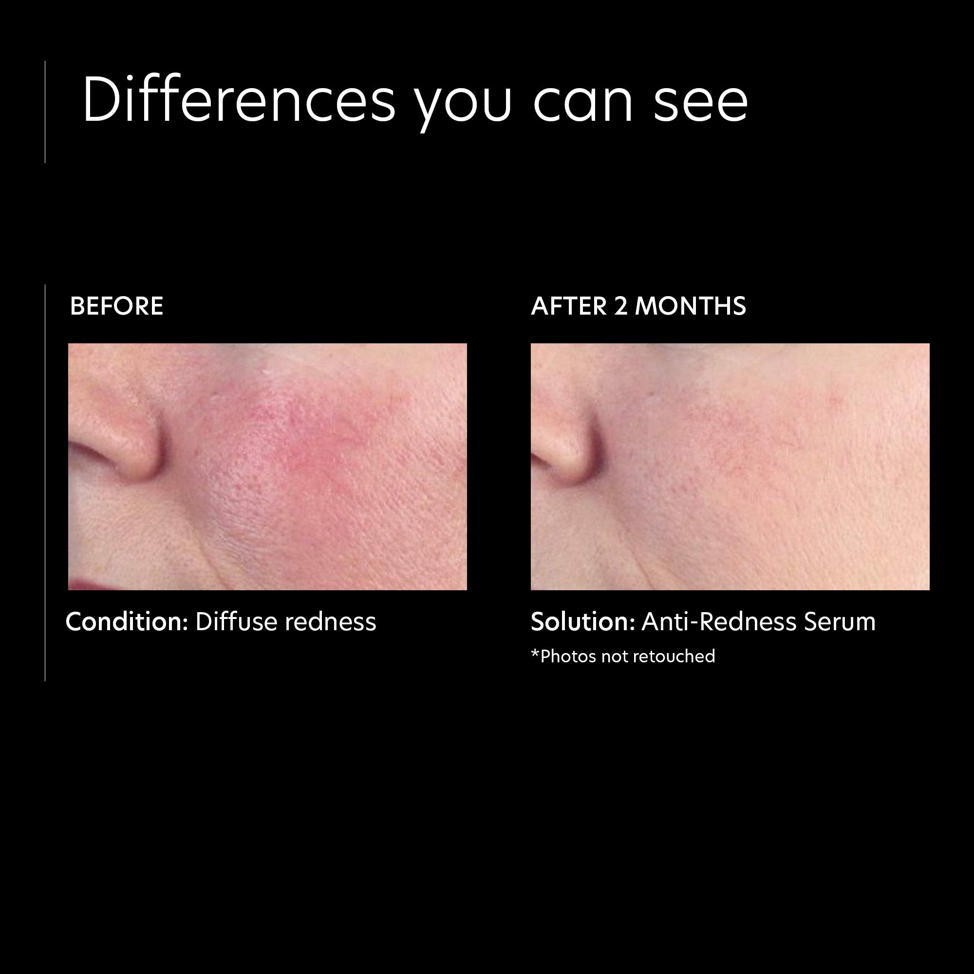 Sérum PCA SKIN Anti-Rougeur – application ciblée sur les zones rouges après l’exercice.