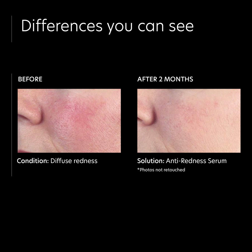 Sérum PCA SKIN Anti-Rougeur – application ciblée sur les zones rouges après l’exercice.
