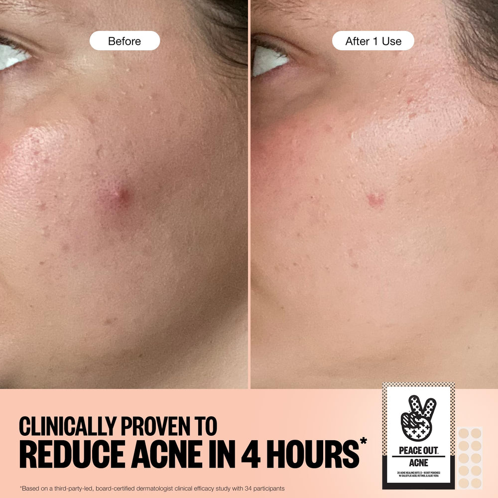 Peace Out Dots protect blemish overnight while you rest