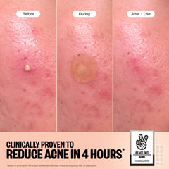 Close-up of Peace Out patch covering a pimple with clarity