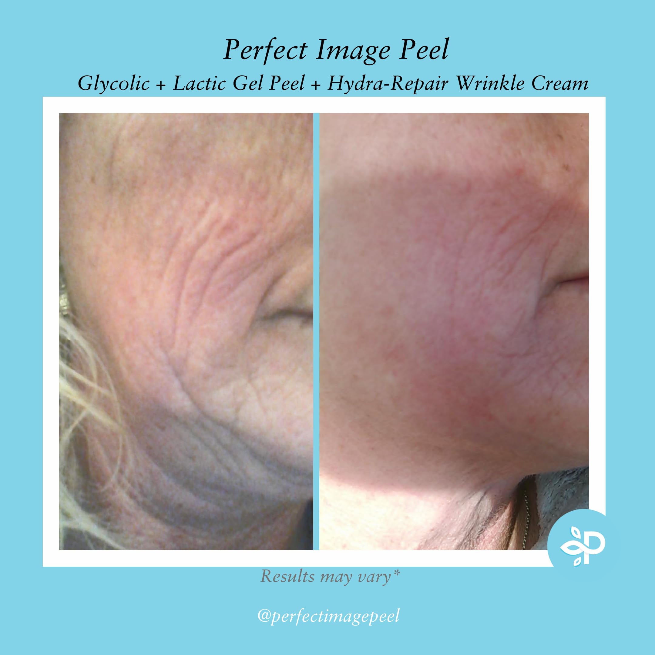 Exfoliation régulière du Glycolic Gel Peel pour un teint plus clair.