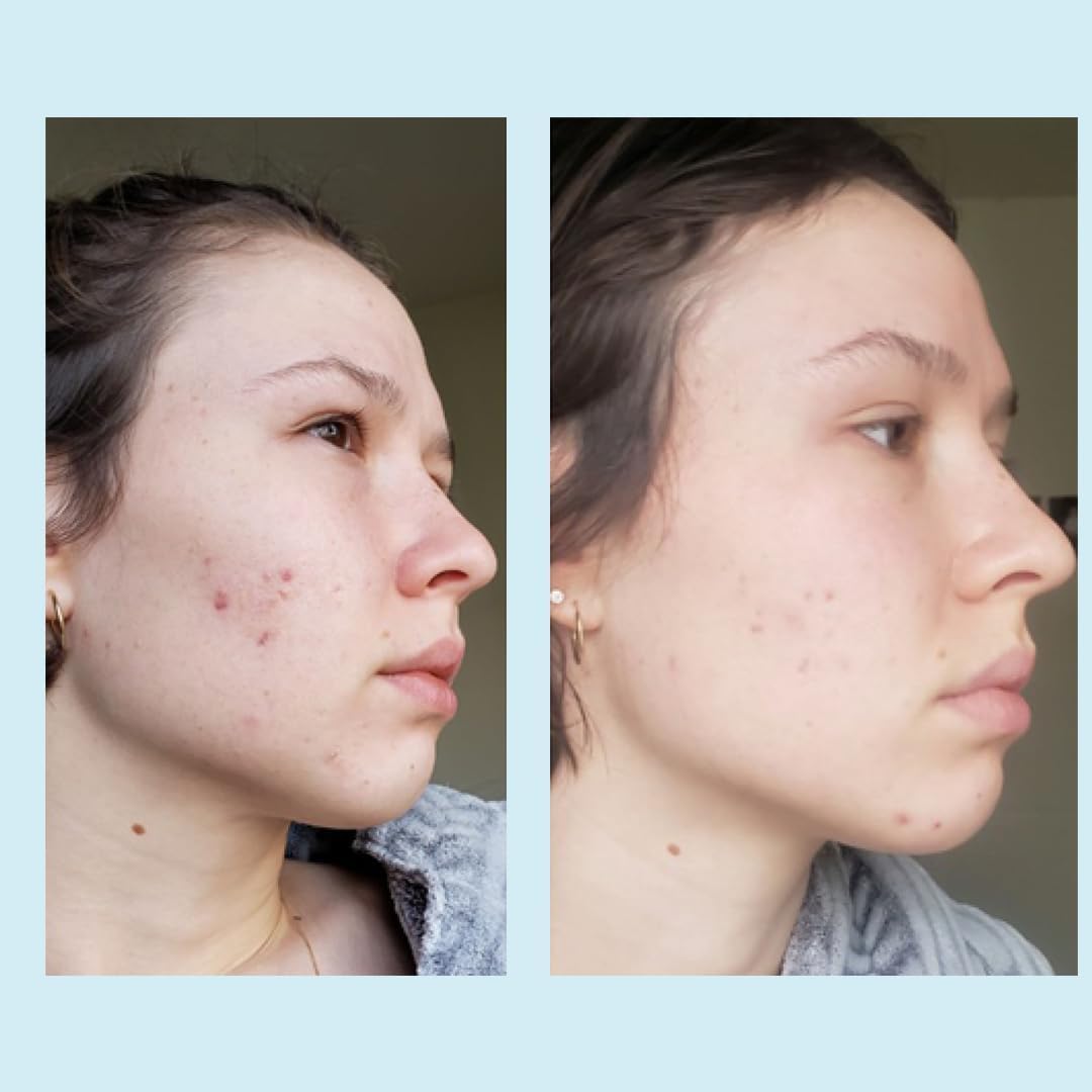 Perfect Image peeling glycolique 50% : exfoliation régulière pour un teint plus net.