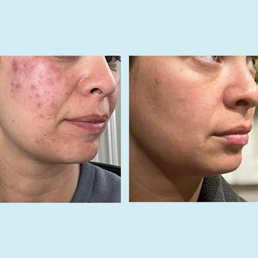 Effet peau plus lumineuse après l’utilisation du Perfect Image peeling glycolique 50%.