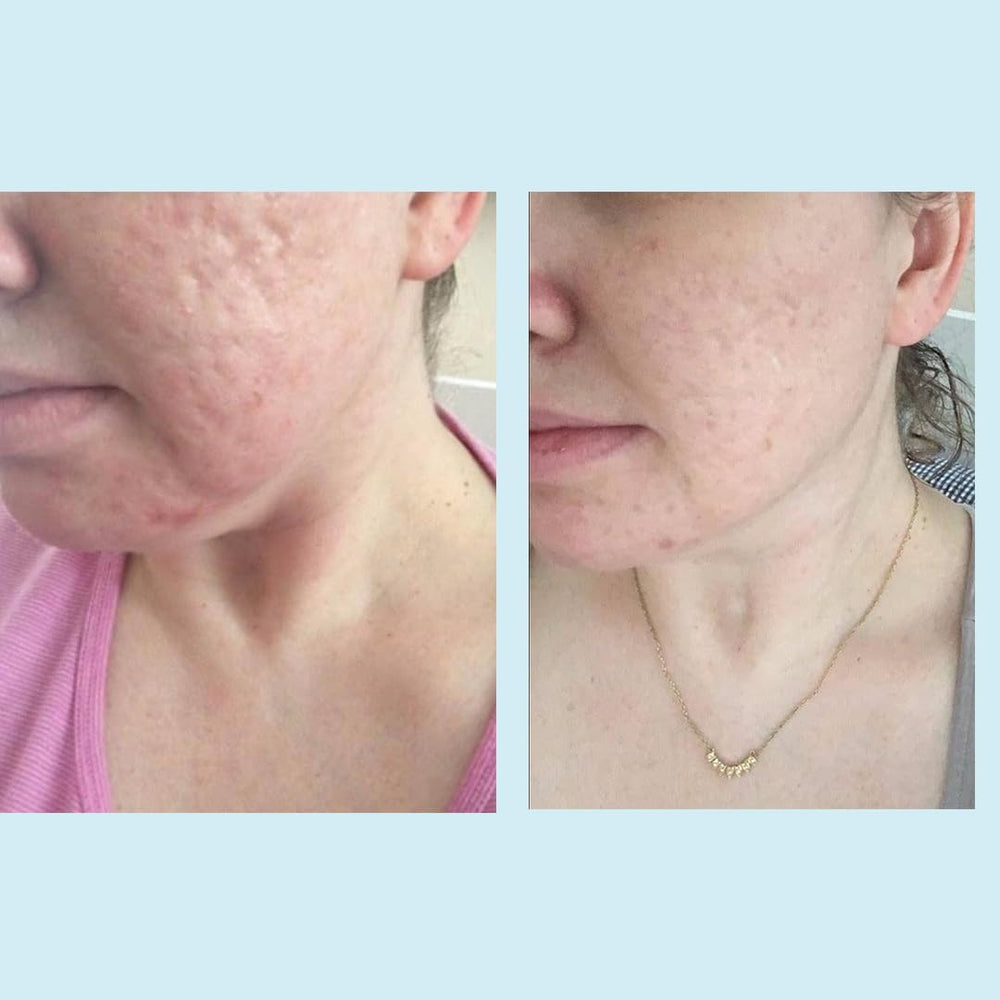 Application recommandée du Perfect Image peeling glycolique 50% pour une peau plus lisse.