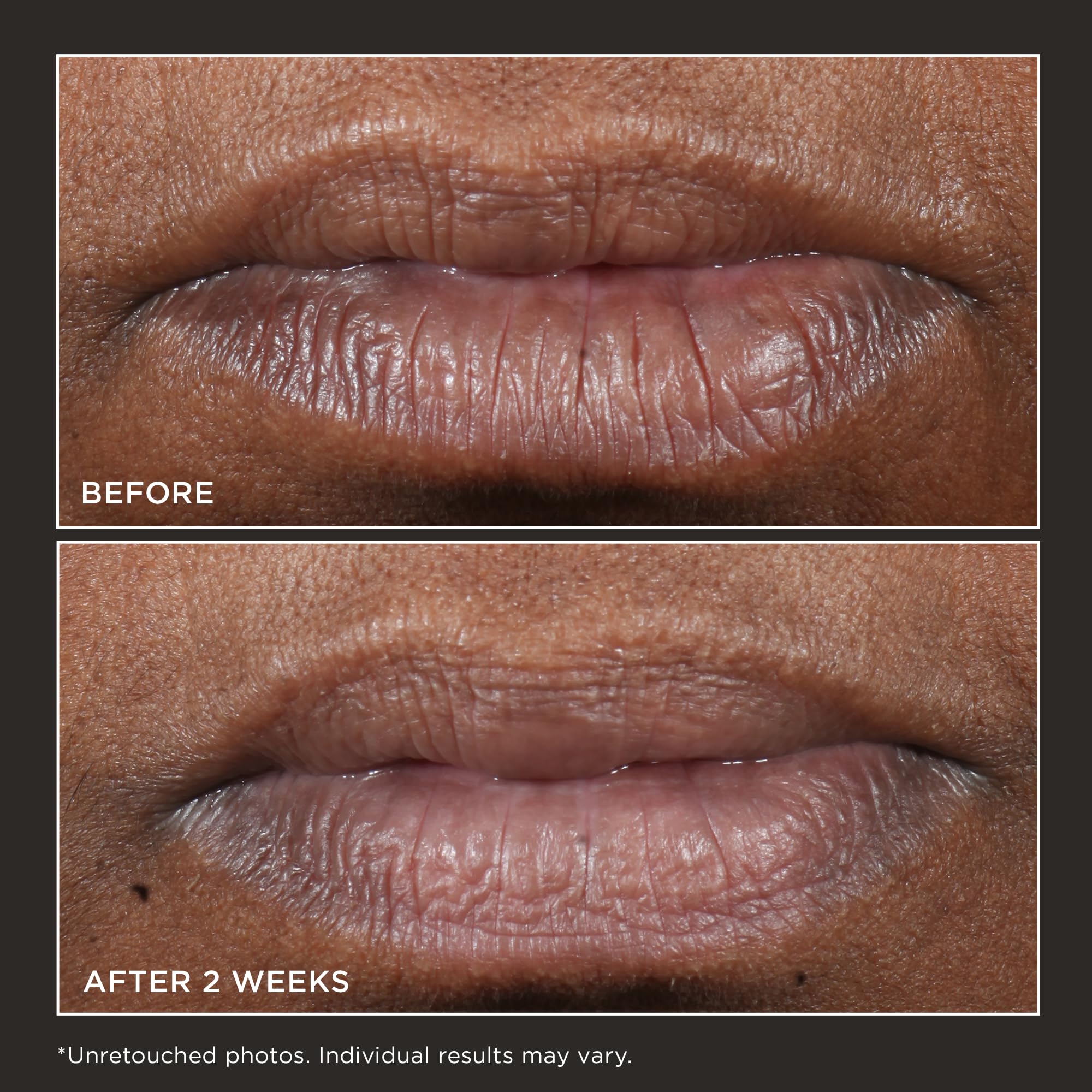 Perricone MD Cold Plasma Plus Lip Therapy agit sur la décoloration des lèvres