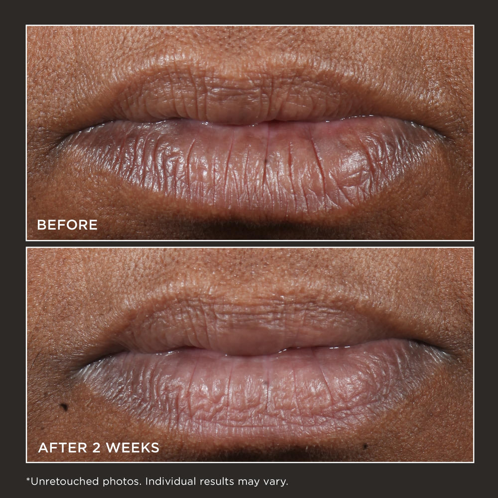 Perricone MD Cold Plasma Plus Lip Therapy agit sur la décoloration des lèvres