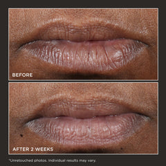 Perricone MD Cold Plasma Plus Lip Therapy agit sur la décoloration des lèvres