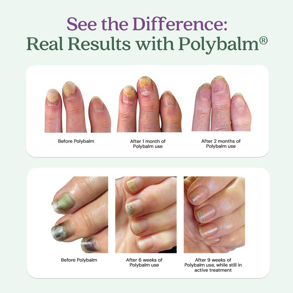 Application du baume Polybalm sur les doigts pour le confort des ongles.
