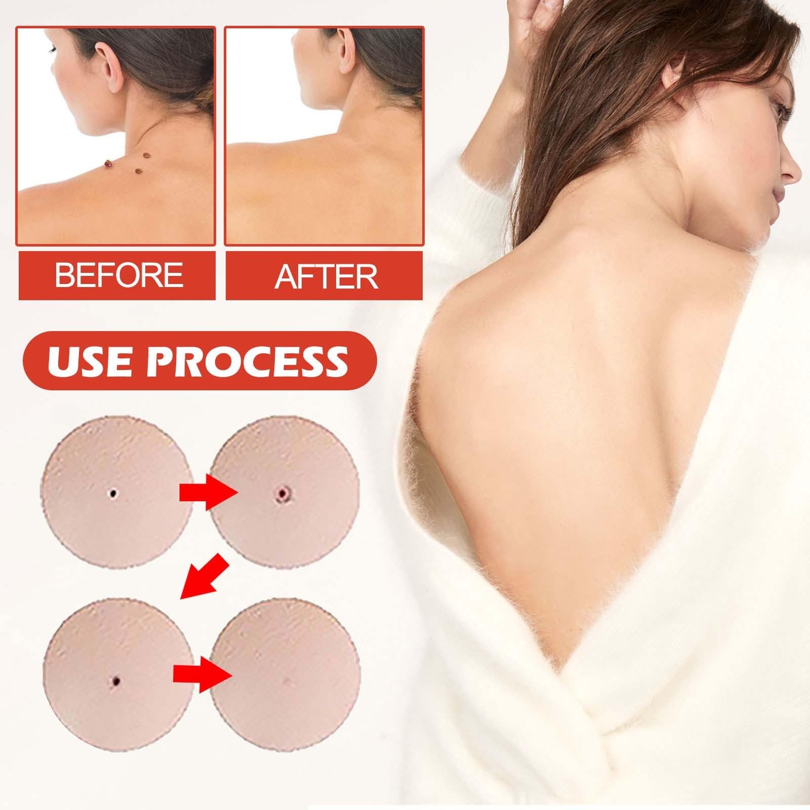 Patch Pro Microdarts formule adaptée à tous types de peau