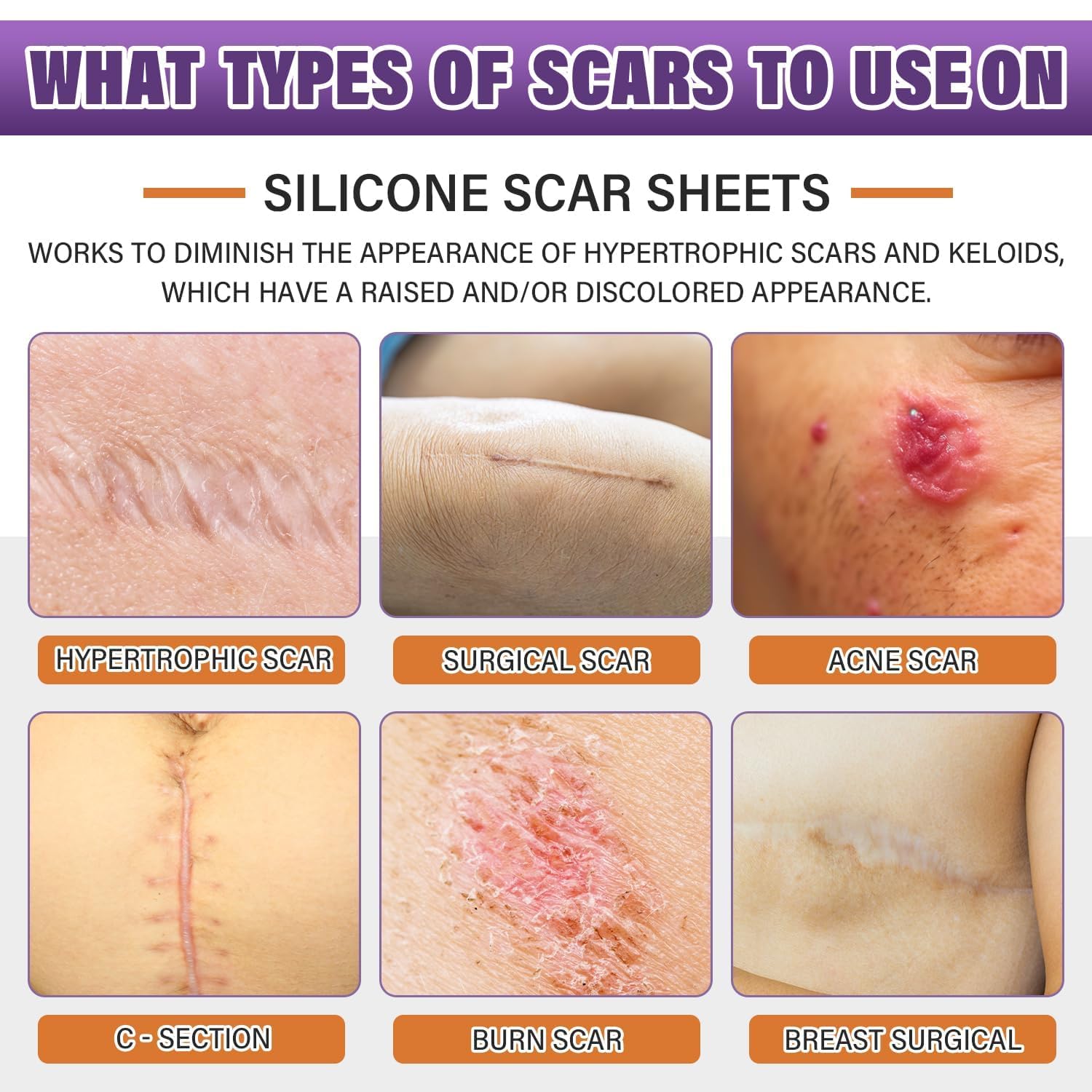 Psecici ruban-silicone-cicatrice-adhesif-1-6x157 protège et adoucit les cicatrices.