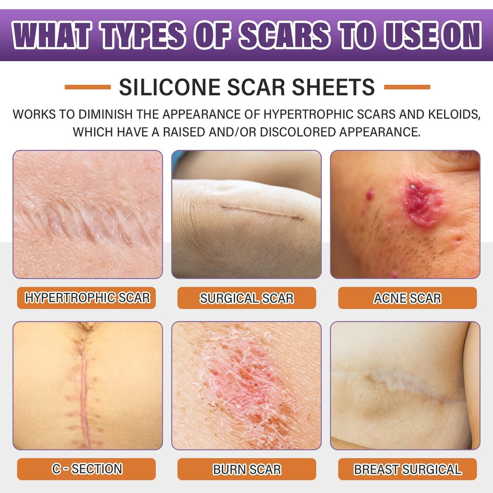 Psecici ruban-silicone-cicatrice-adhesif-1-6x157 protège et adoucit les cicatrices.