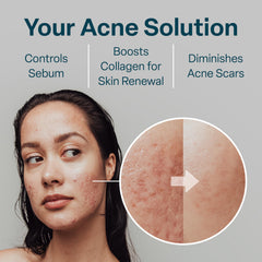 Formule avec glycolique 10% et salicylique 2% pour exfolier efficacement