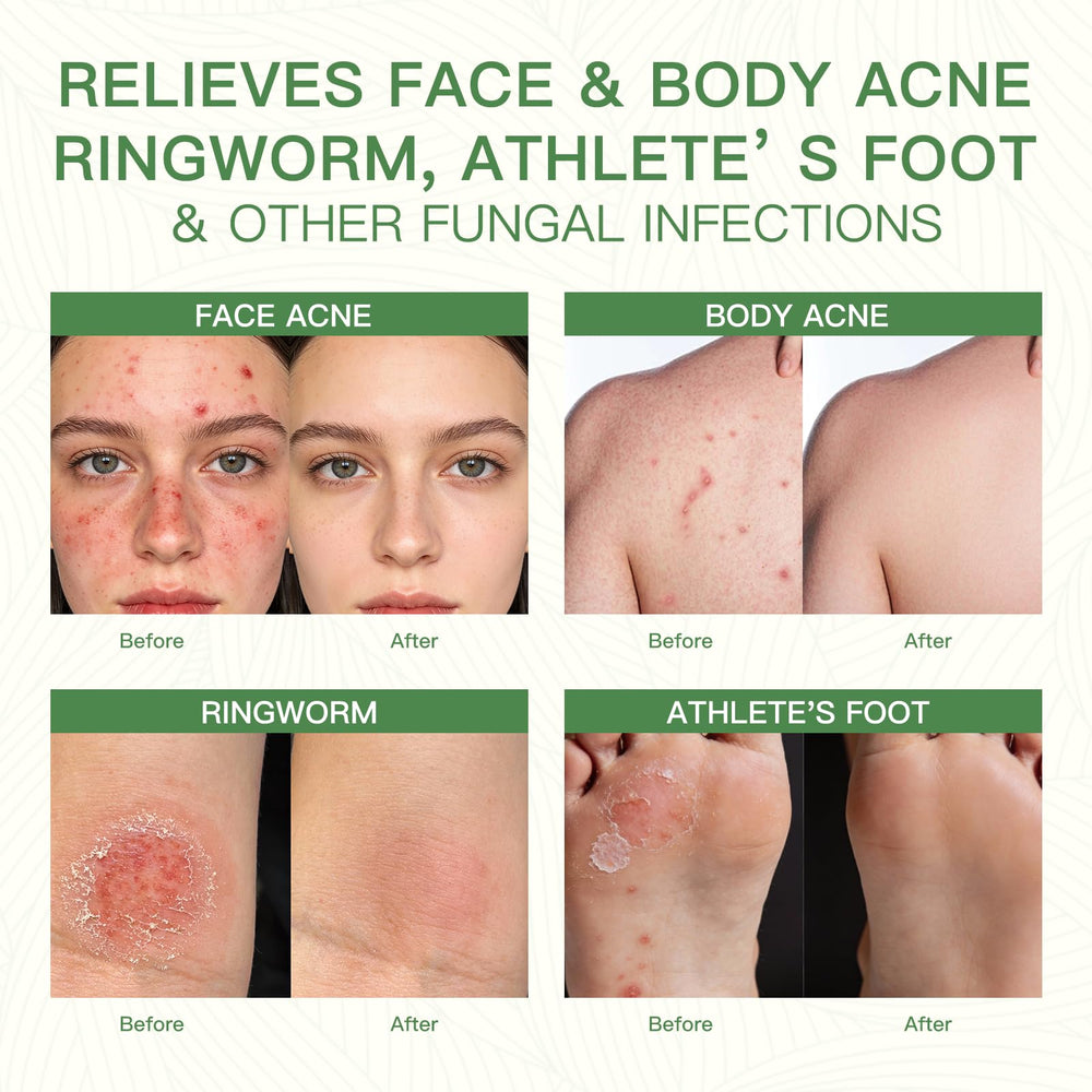 QualiLife Tea Tree Soap soothing relief for itching and redness on skin.