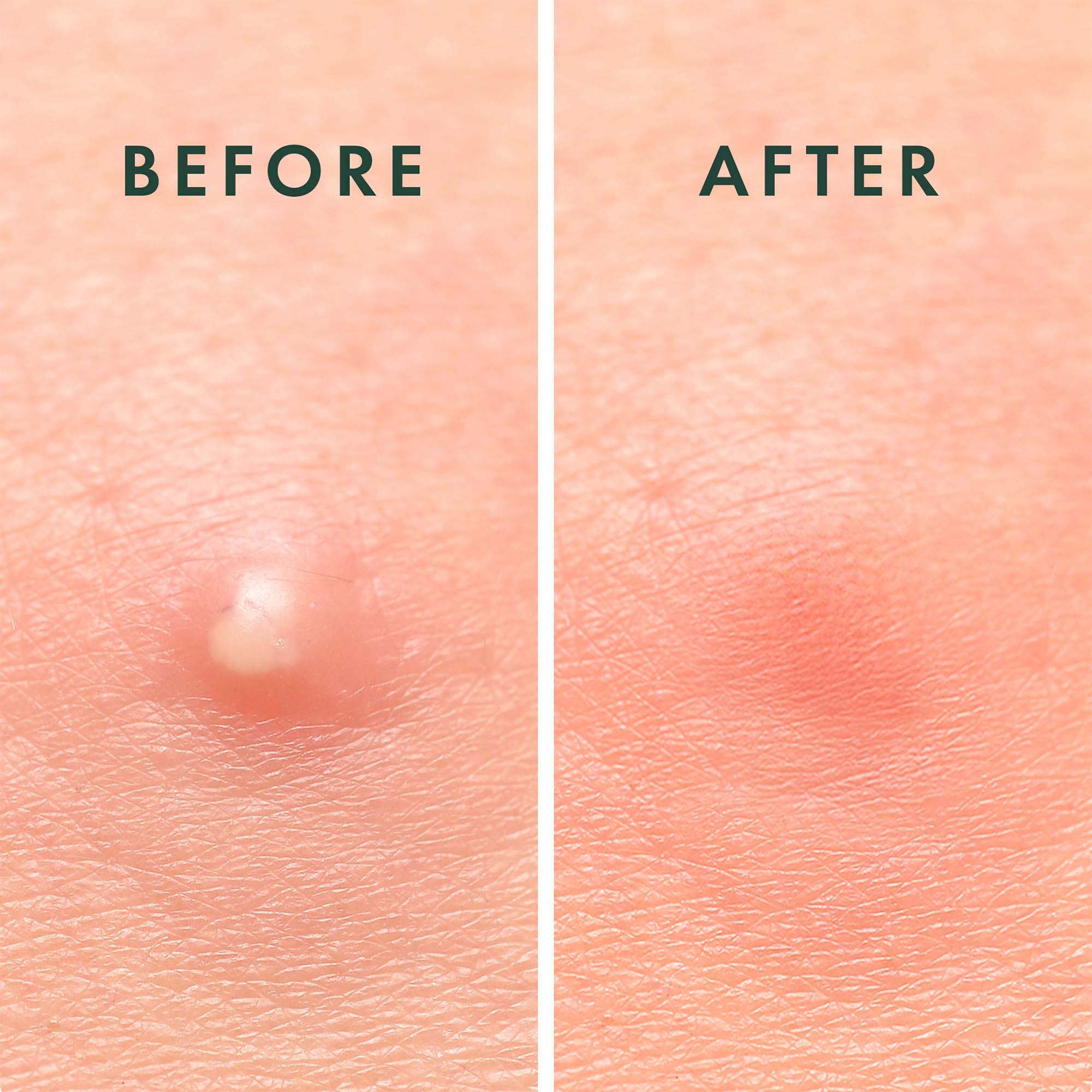 Rael hydrocolloid patch applied to acne for overnight care.