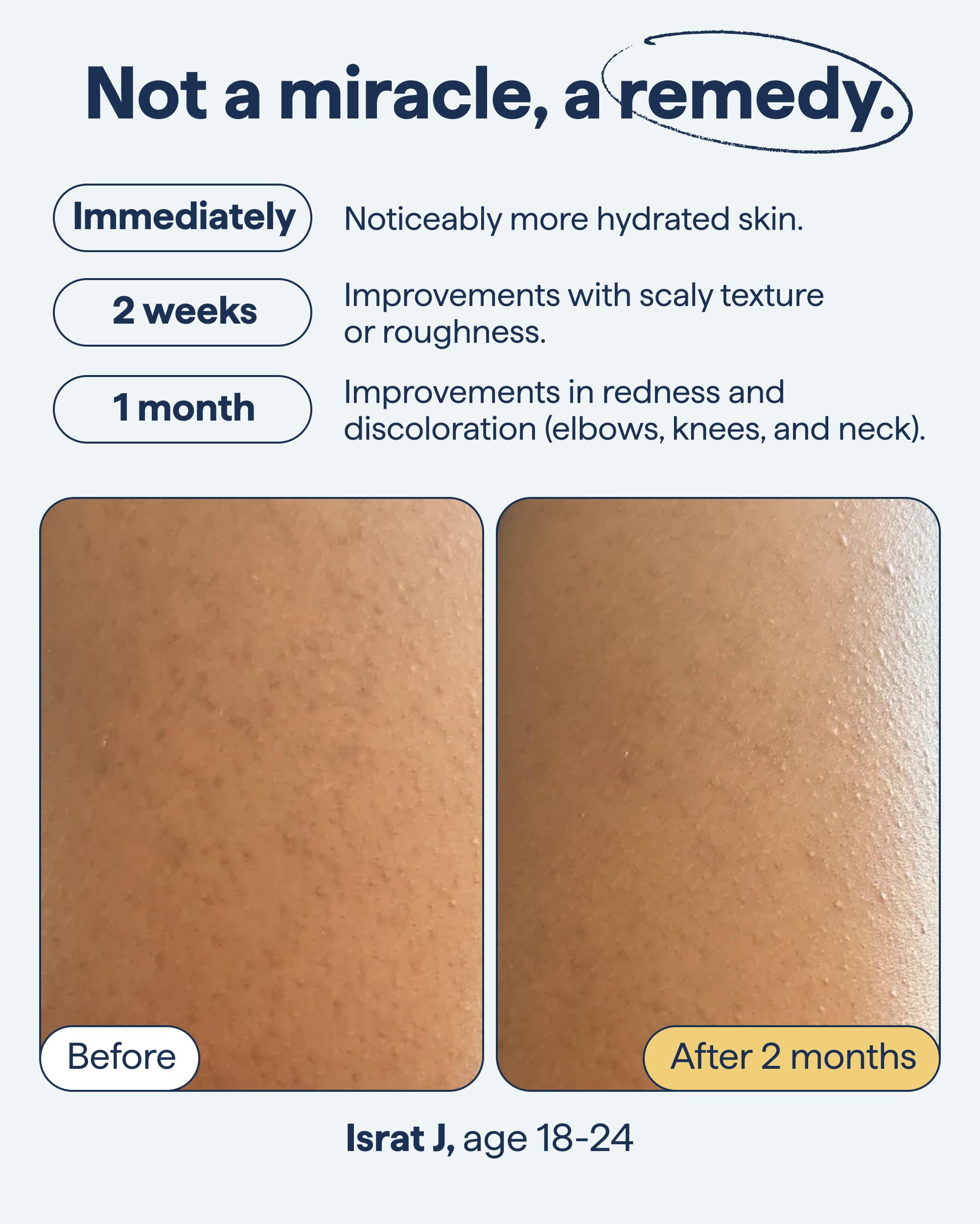 Remedy Science Urée Lactique Rétinol: exfoliation douce.
