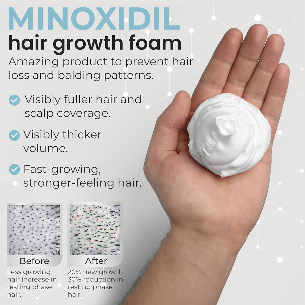 Remixidil Homme 5% Minoxidil Mousse, aide potentielle à densifier les cheveux.