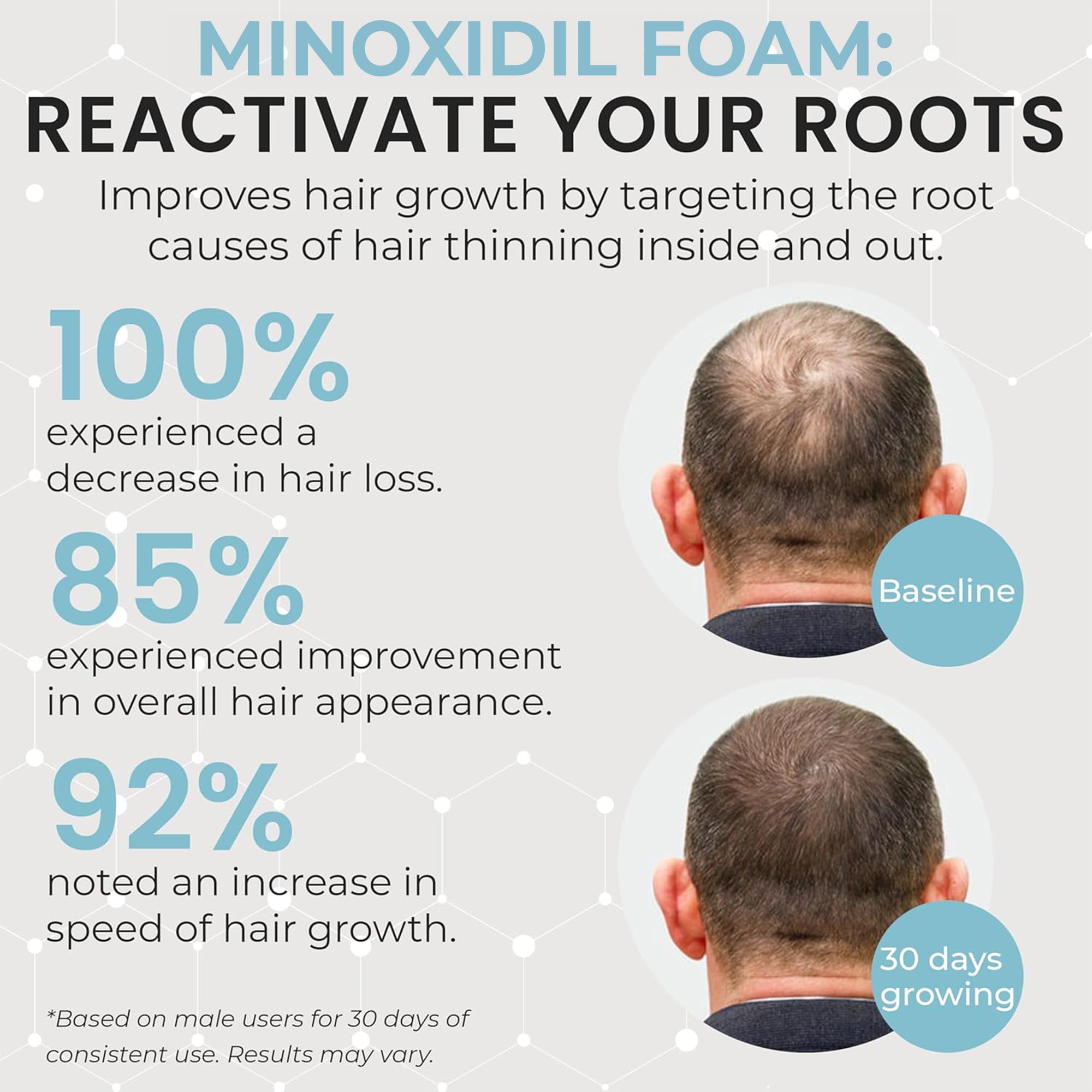 Remixidil Homme 5% Minoxidil Mousse, densité capillaire visée avec utilisation régulière.