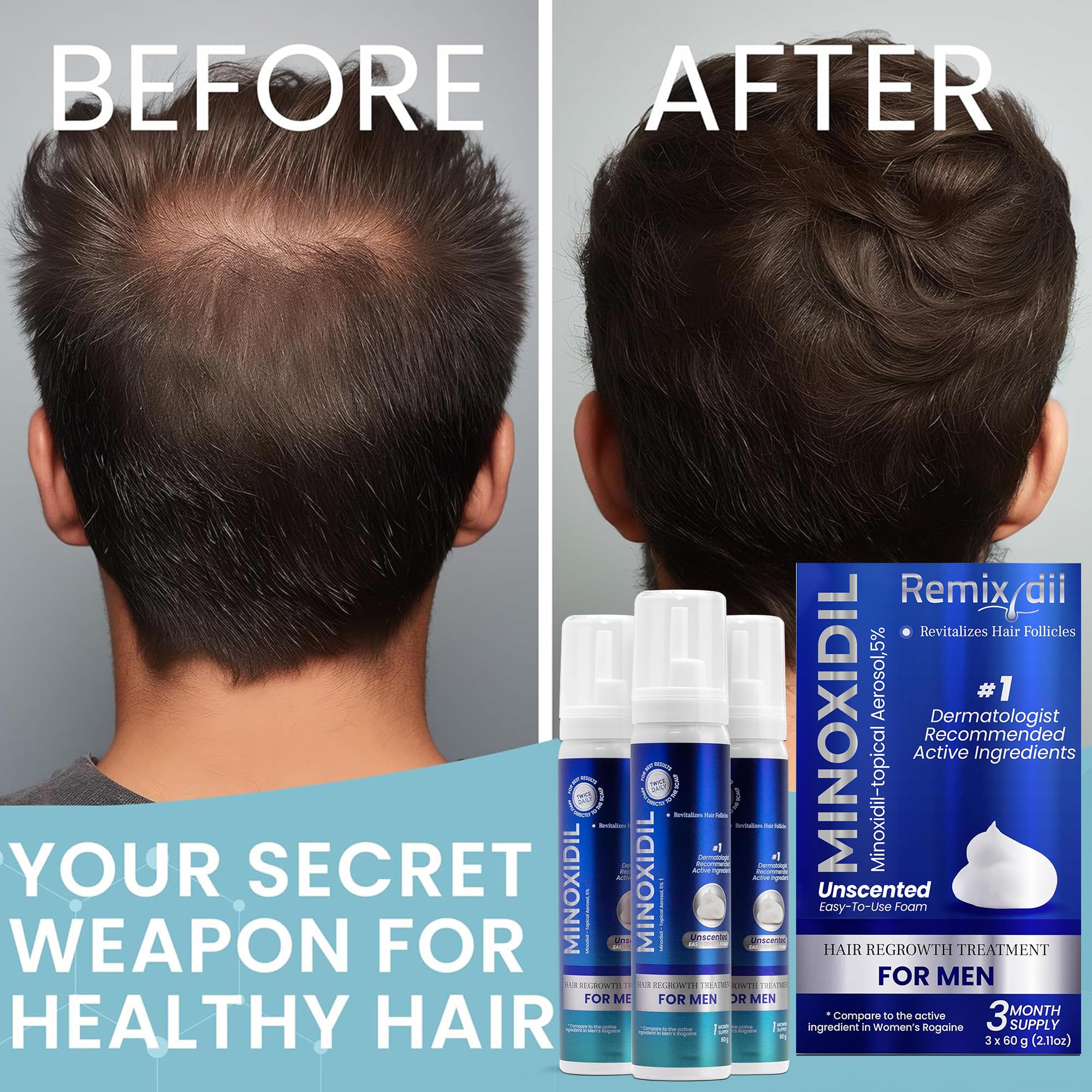 Remixidil Homme 5% Minoxidil Mousse, utilisation stable et simple chaque jour.