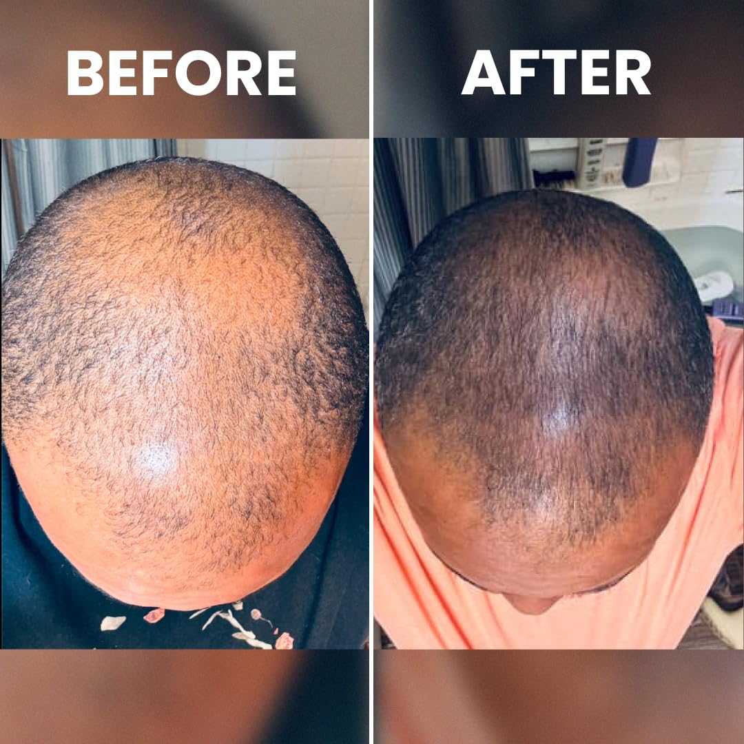 Massage du cuir chevelu avec le sérum Rennora pour absorption efficace.