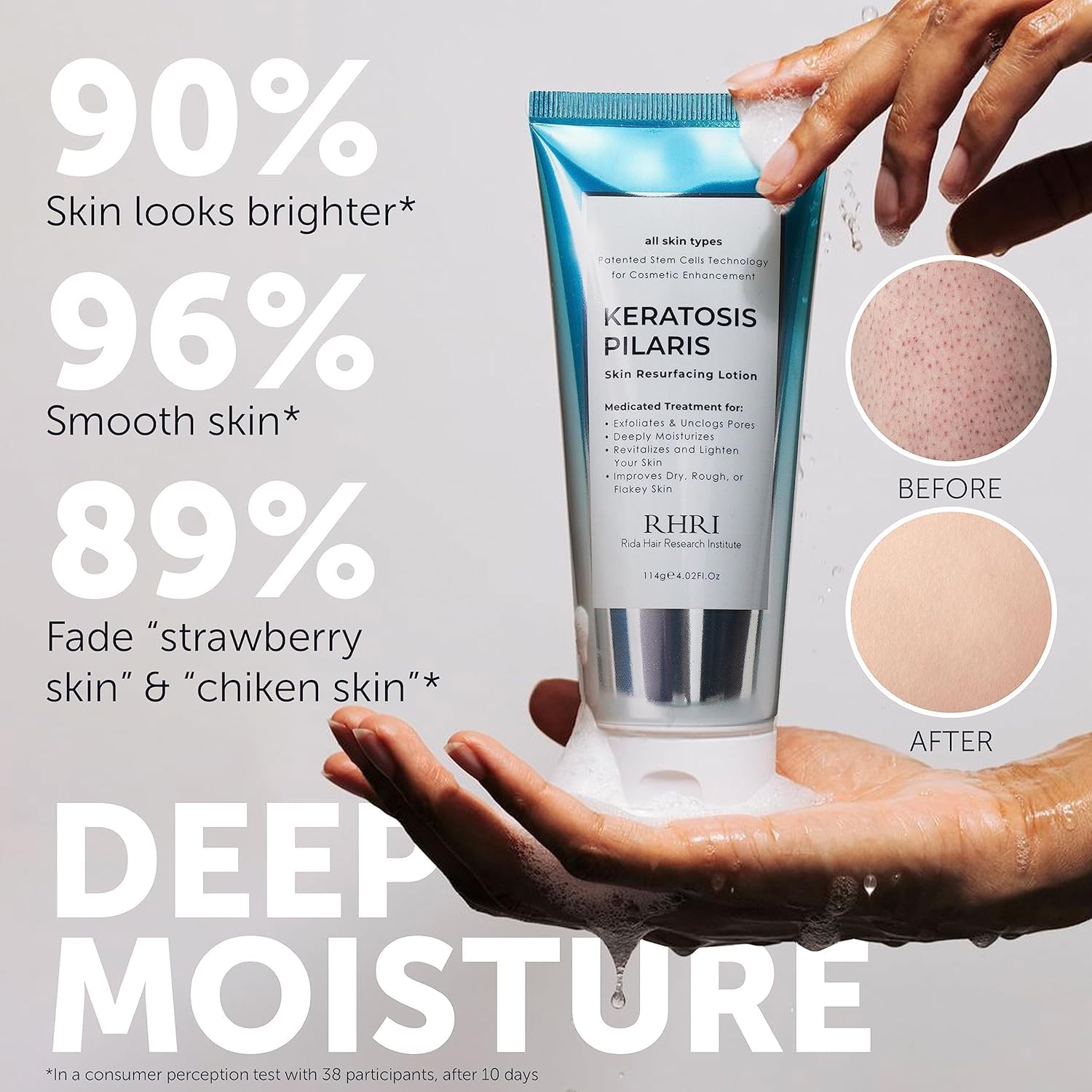 Rida Traitement keratose pilaire, texture crème, exfoliation douce pour peau lisse.