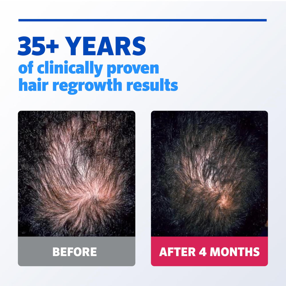 Rogaine 5% Minoxidil – zone vertex et ciblage de l’affinement naissant.