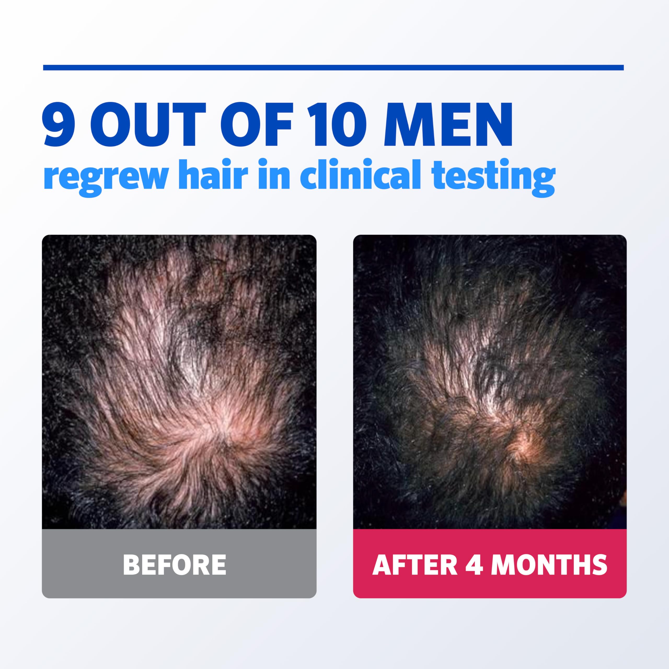 Rogaine Mousse 5% pour homme, absorption rapide sans résidu.