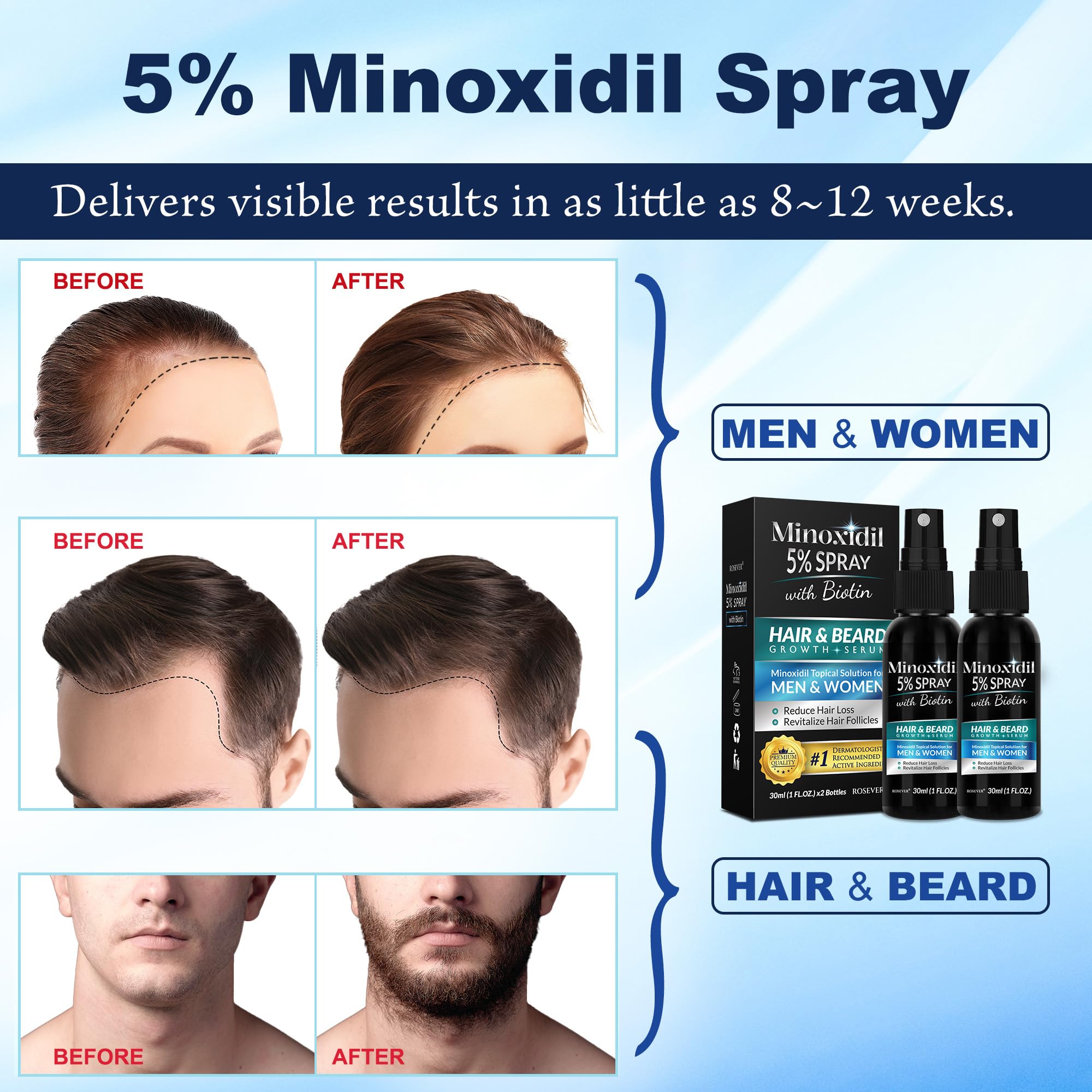 Rosever minoxidil spray applied to beard area for growth focus.