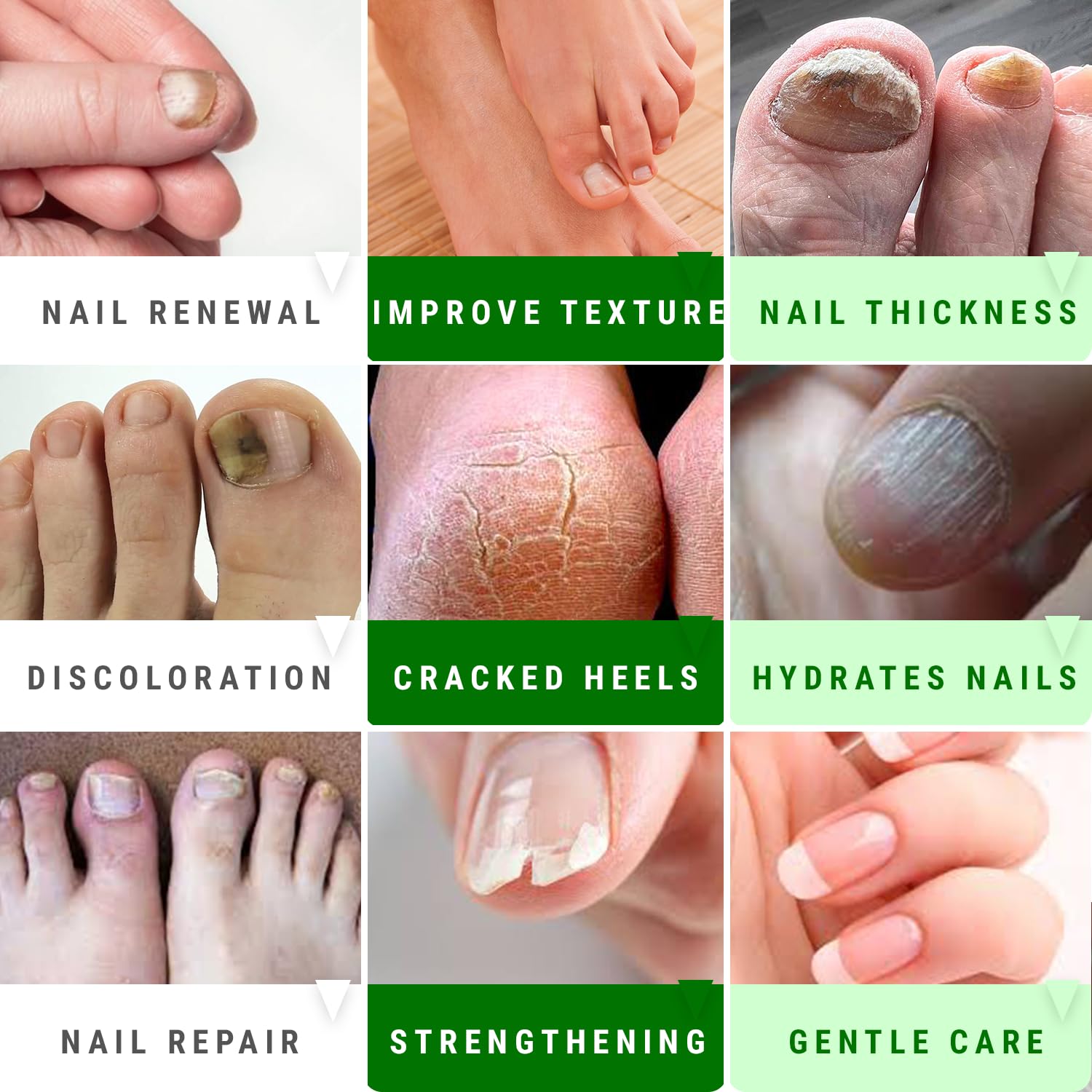 Ongles blanchis et revitalisés grâce au gel urea-nail Scientific Solutions Global