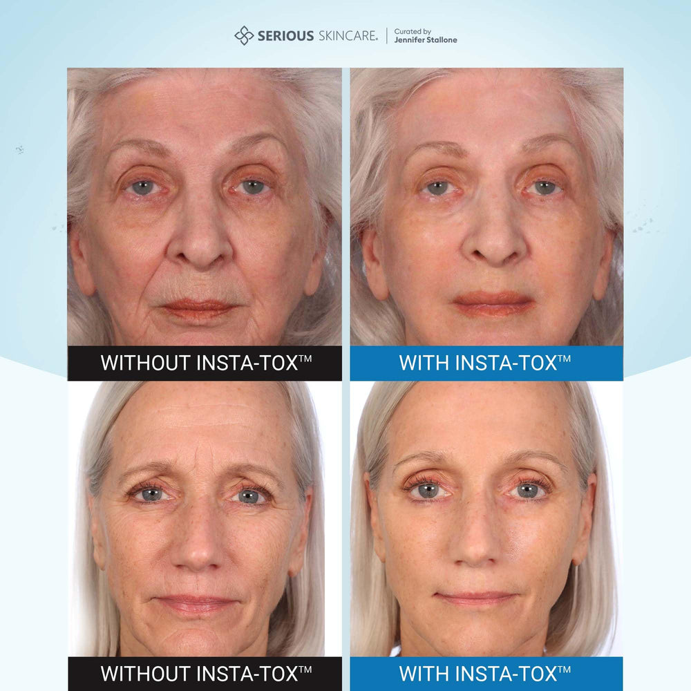 Rides profondes visiblement atténuées sur le visage avec INSTA-TOX
