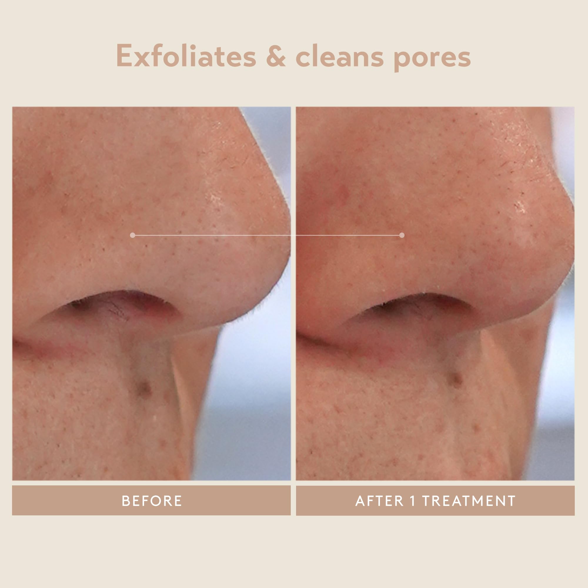 SHANI DARDEN Triple Acid Peel – kaolin et argile aidant à nettoyer les pores et matifier.