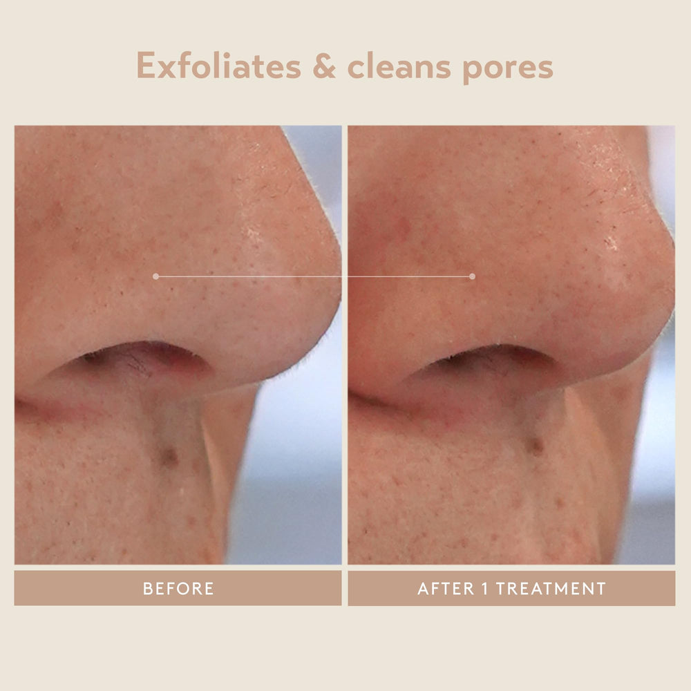 SHANI DARDEN Triple Acid Peel – kaolin et argile aidant à nettoyer les pores et matifier.