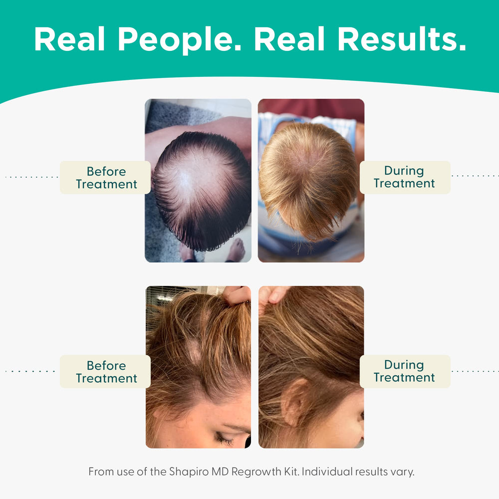 Cheveux plus épais et sains après Shapiro MD.