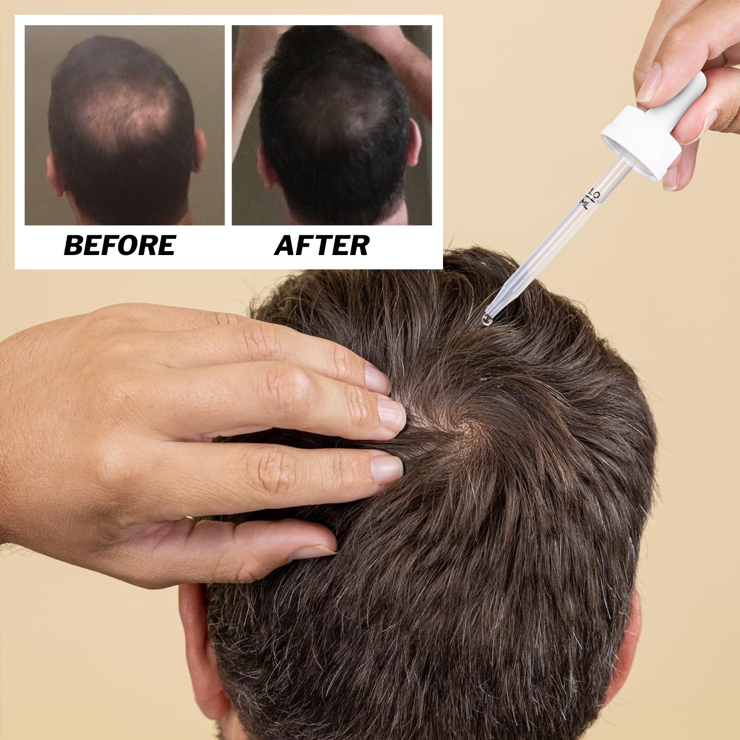 Shapiro MD Regrowth Kit Anti-chute: solution complète pour cheveux plus fournis.