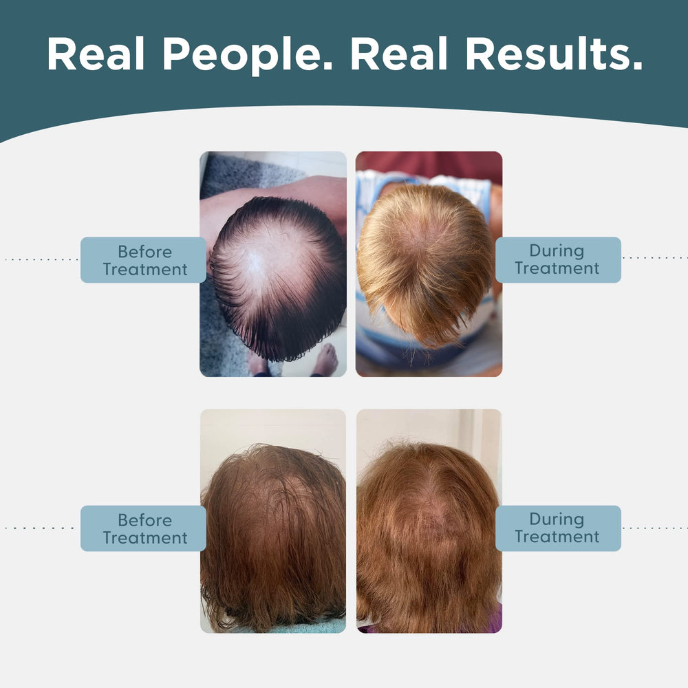 Shapiro MD Minoxidil 5% routine-quotidienne, facile à intégrer.
