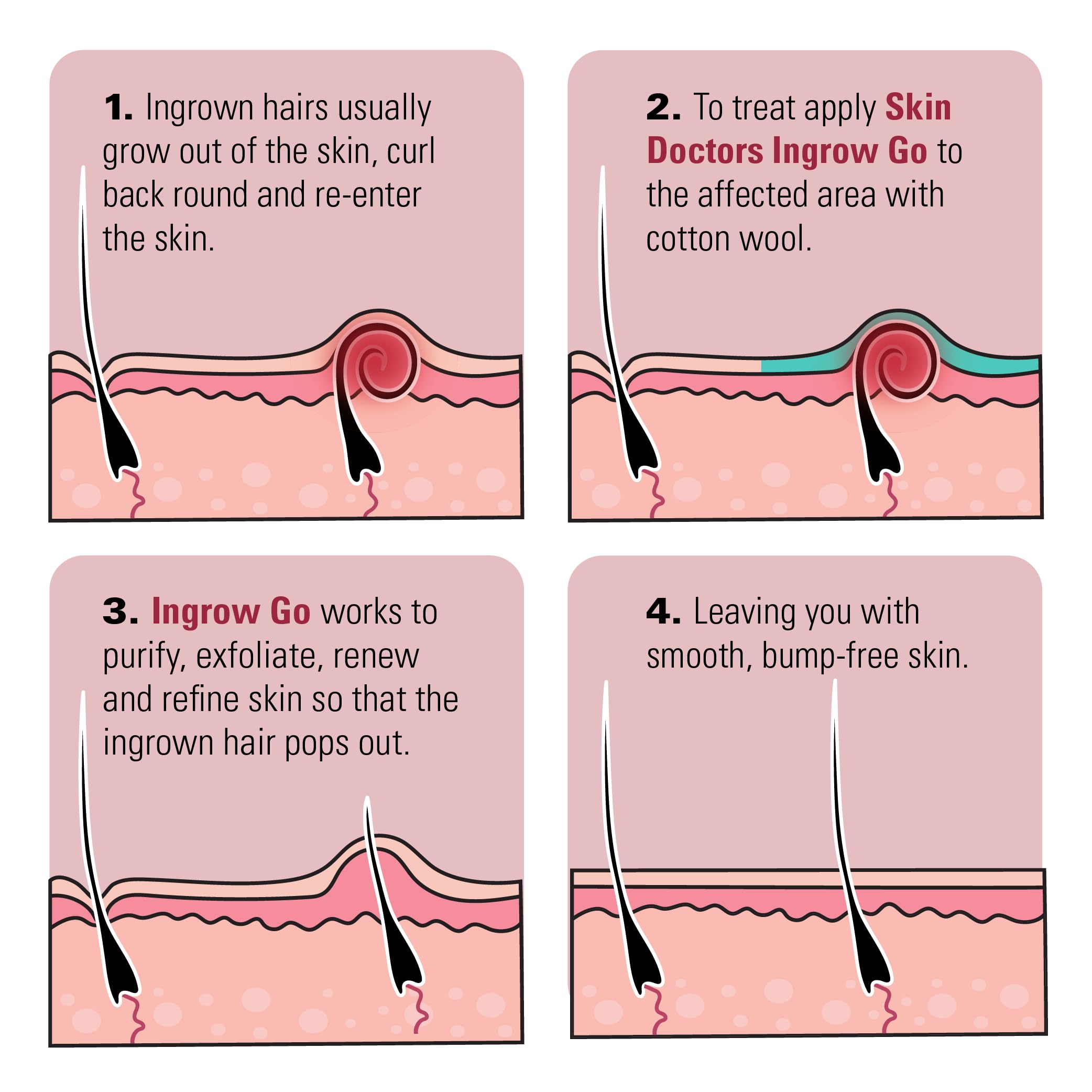 Pores nettoyés et purifiés grâce à Skin Doctors Ingrow Go.