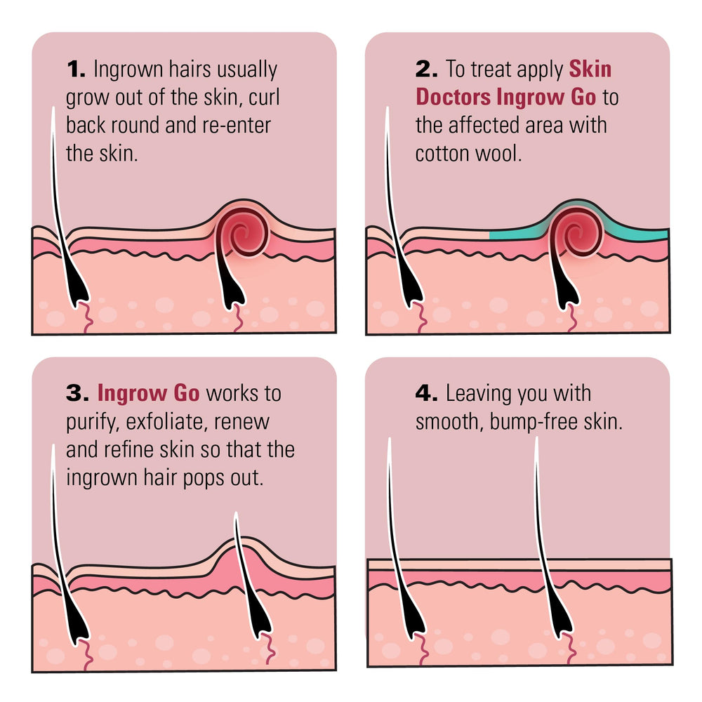 Pores nettoyés et purifiés grâce à Skin Doctors Ingrow Go.