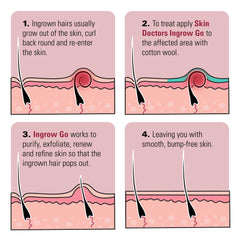 Pores nettoyés et purifiés grâce à Skin Doctors Ingrow Go.