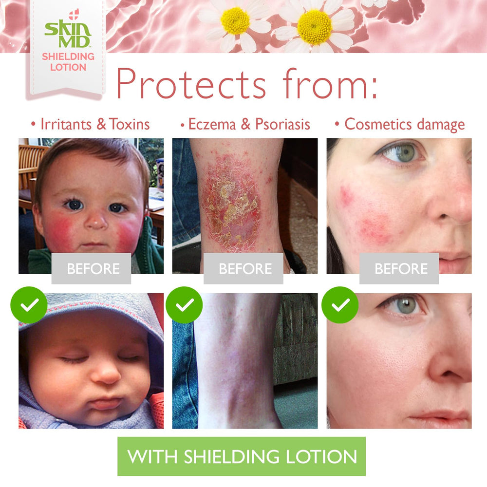 Sans parfum et sans colorant, Skin MD Shielding Lotion convient aux peaux sensibles