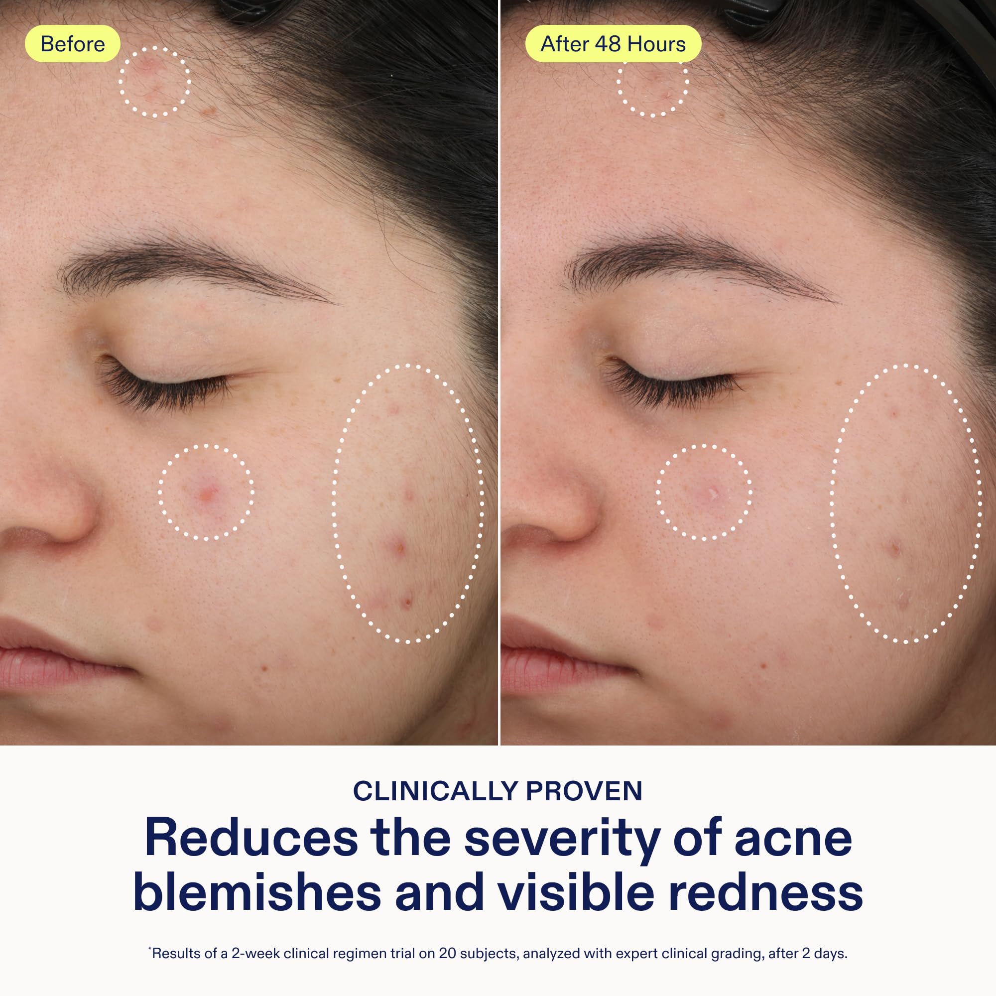 Skinfix 2% BHA Spot Treatment – application ciblée sur une zone.